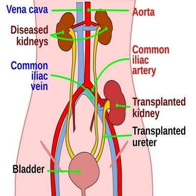 Kidney transplant operation